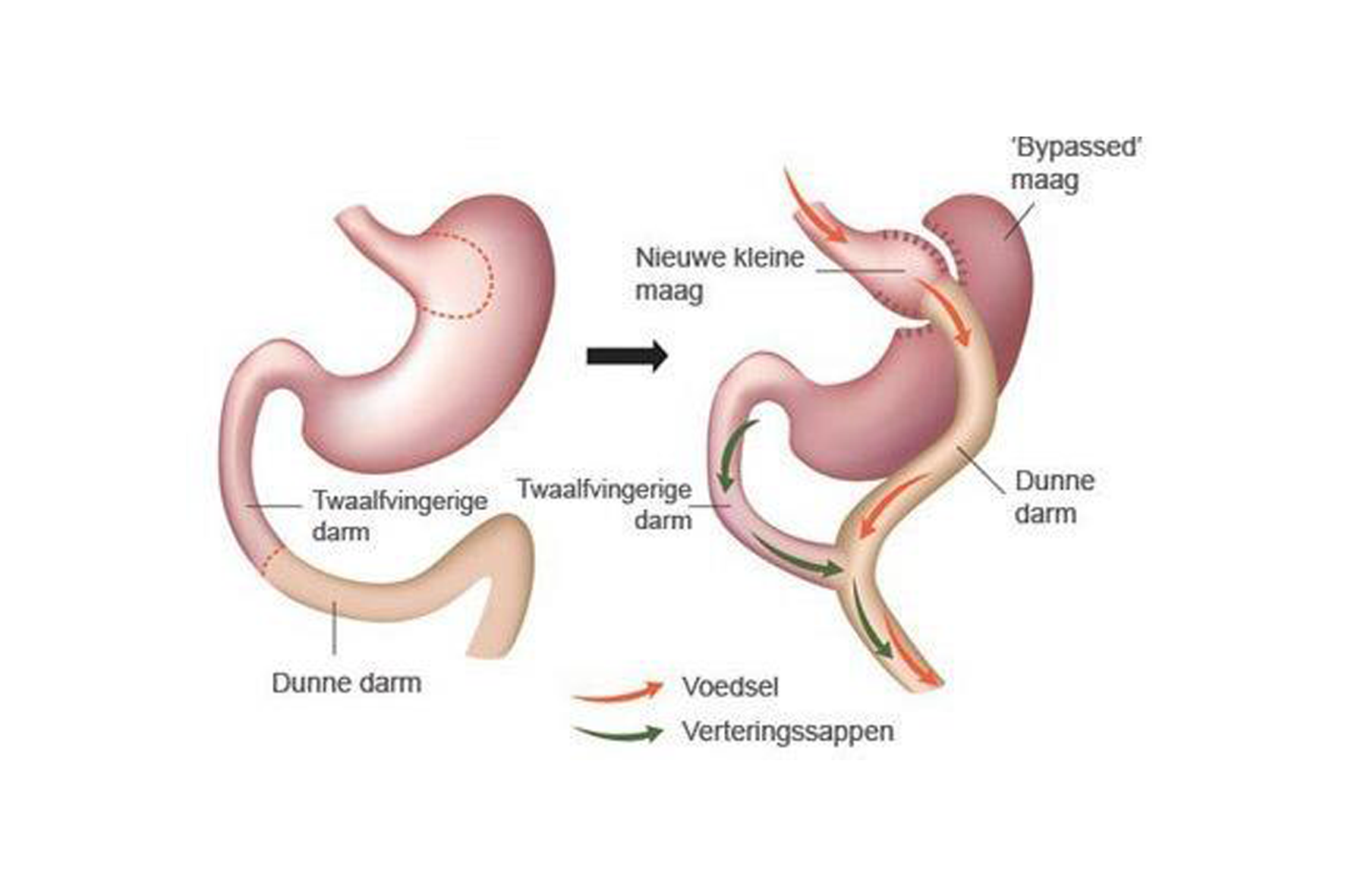 Gastric Bypass