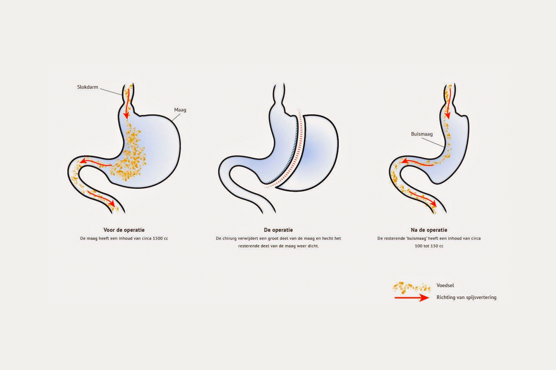 Gastric Sleeve