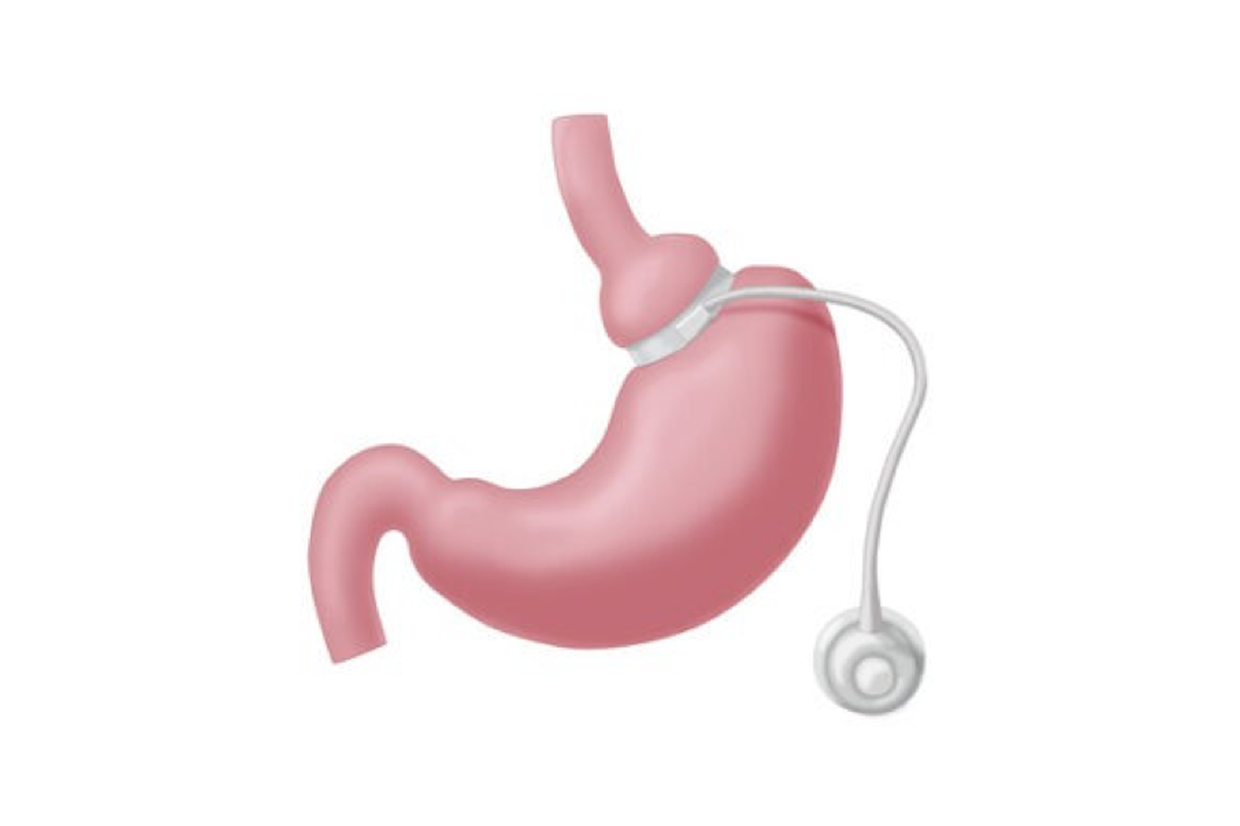 Gastric Banding